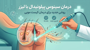درمان سینوس پیلونیدال با لیزر؛ روشی جدید برای درمان کیست مویی